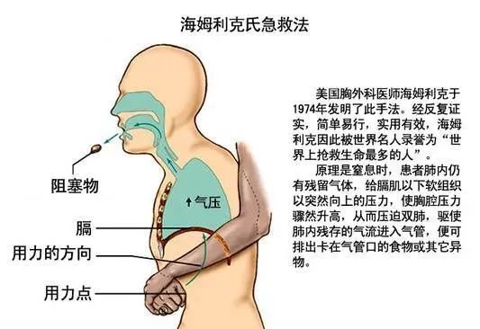 海姆立克急救法可以不用但不能不会海姆立克急救法，可以不用，但不能不会